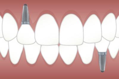 hygiene des implants dentaires aubervilliers